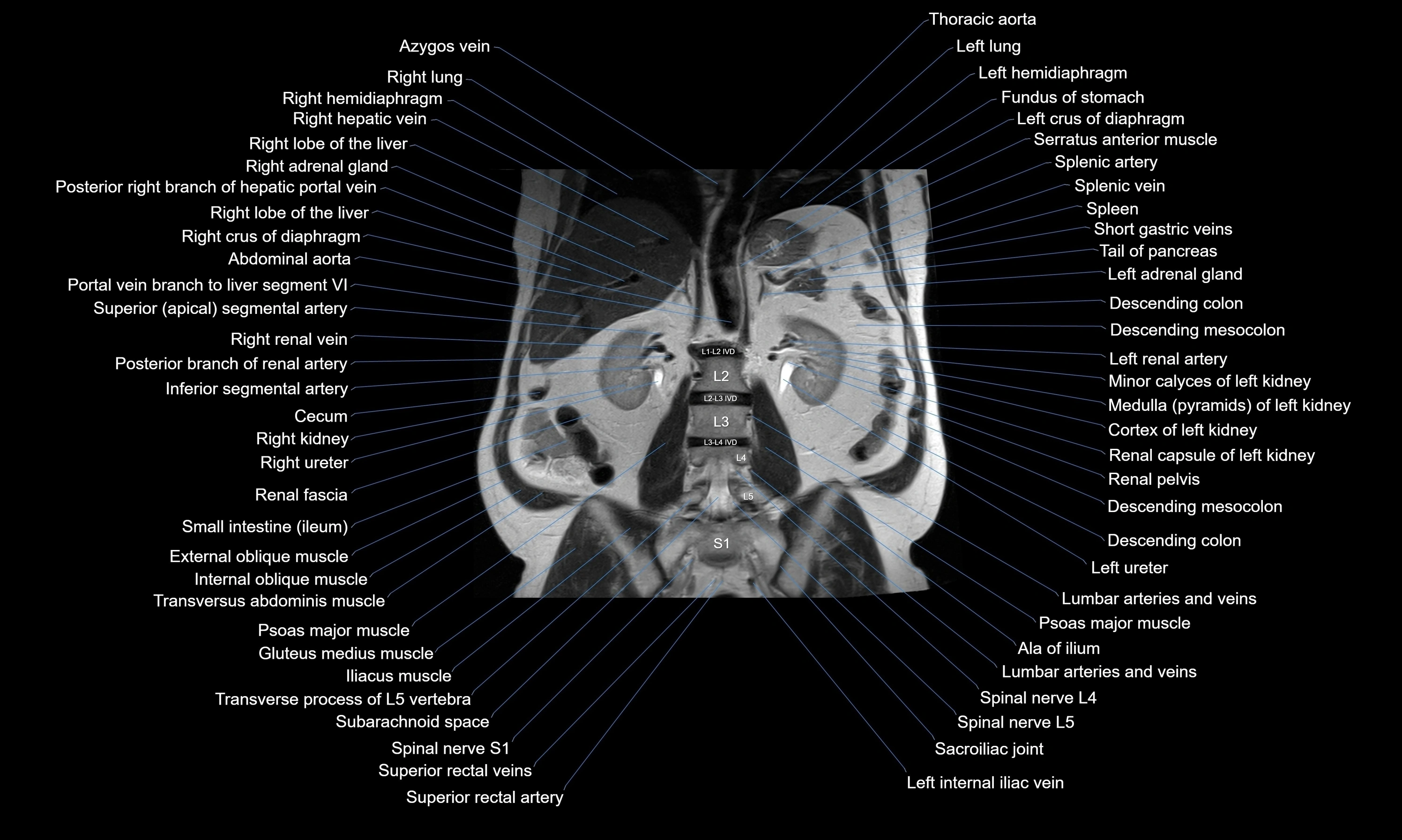 MRI Abdomen axial cross sectional anatomy radiology  image-img-00001-00037.webp